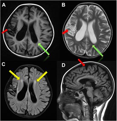 Acute Lymphoblastic Leukemia in Combined Methylmalonic Acidemia and Homocysteinemia (cblC Type): A Case Report and Literature Review